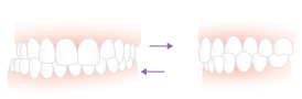 Cross bite